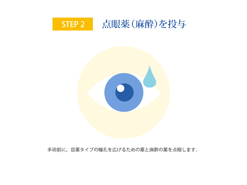STEP2 点眼薬（麻酔）を投与 手術前に、目薬タイプの瞳孔を広げるための薬と麻酔の薬を点眼します。